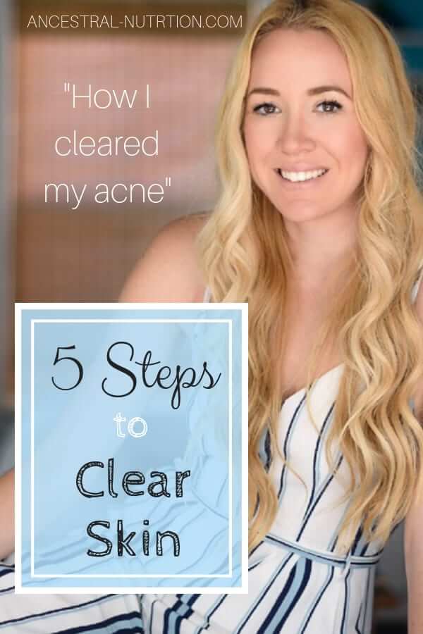 5 Steps to Clear Skin aka. How I got rid of my severe acne! Tired of blackheads and acne? Follow these simple 5 steps and you will have the clearest skin of your life - all naturally by detoxing, changing your diet and using essential oils. #natural, #DIY, #beauty, #skincare, #acne, #remedies