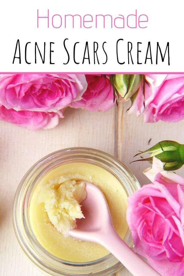 Homemade Acne Scars Cream - this homemade product with cocoa butter and essential oils is one of the most effective natural remedies and will help you get rid of acne sacrs #acne, #remedies 