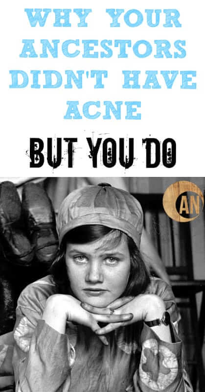 Why Your Ancestors Didn't Have Acne But You Do - find out how diet and lifestyle factors can help clear acne and other skin issues!