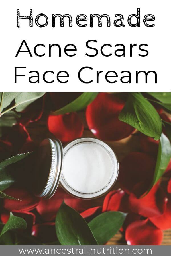 Homemade Acne Scars Cream - this homemade product with cocoa butter and essential oils is one of the most effective natural remedies and will help you get rid of acne scars #acne, #remedies #diy #beauty