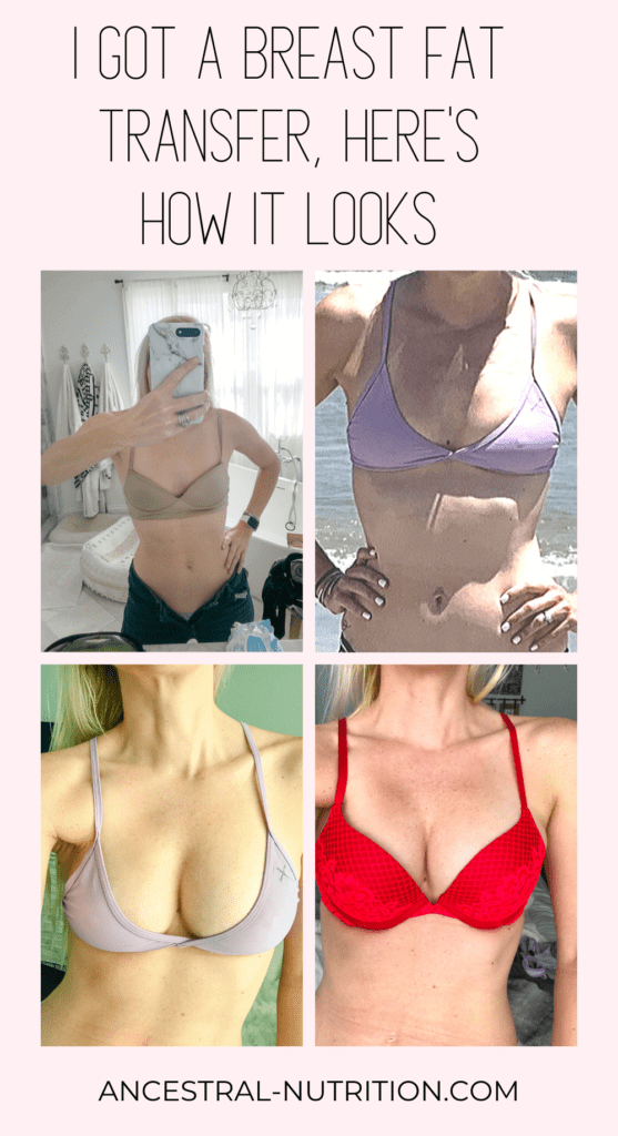  This health and fitness blogger shares her experience with breast augmentation with fat transfer procedure which she had done after breastfeeding several children. See her honest before and after shots, learn about pros and cons, risks and side effects,  and find out whether or not she regrets it #breastaugmentation #fattransfer #beforeandafter #makeover #plasticsurgery