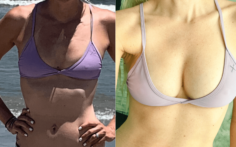 Breast Augmentation with Fat Transfer (No Implants) Archives