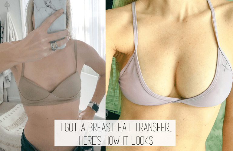 Fat Transfer To Breasts Post-Operative