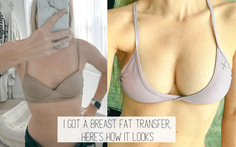 Before and After Breast Fat Transfer - Ancestral Nutrition