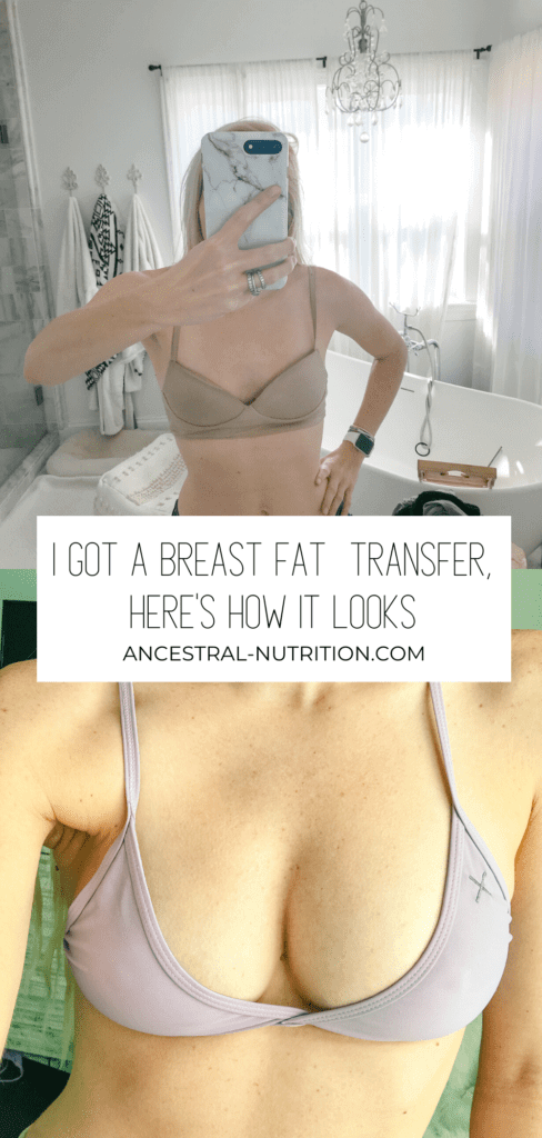 Before and After Breast Fat Transfer - Ancestral Nutrition