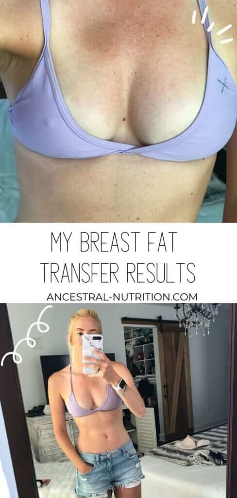 Bednar Cosmetic on X: Here's a Before & After of a Fat Transfer