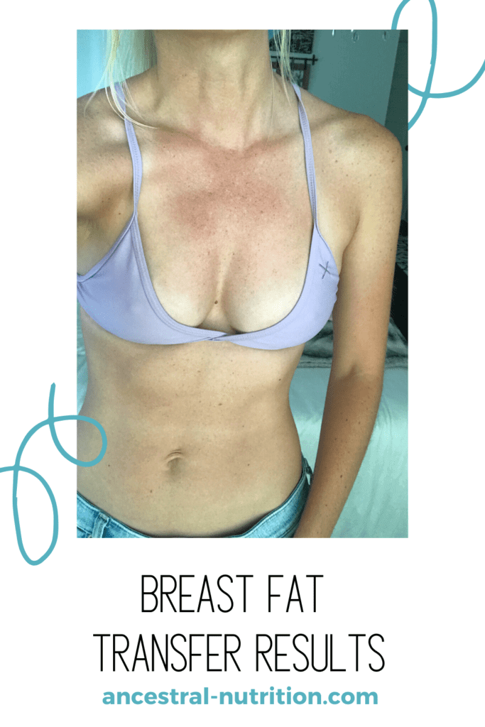 My Breast Fat Transfer Results - Ancestral Nutrition