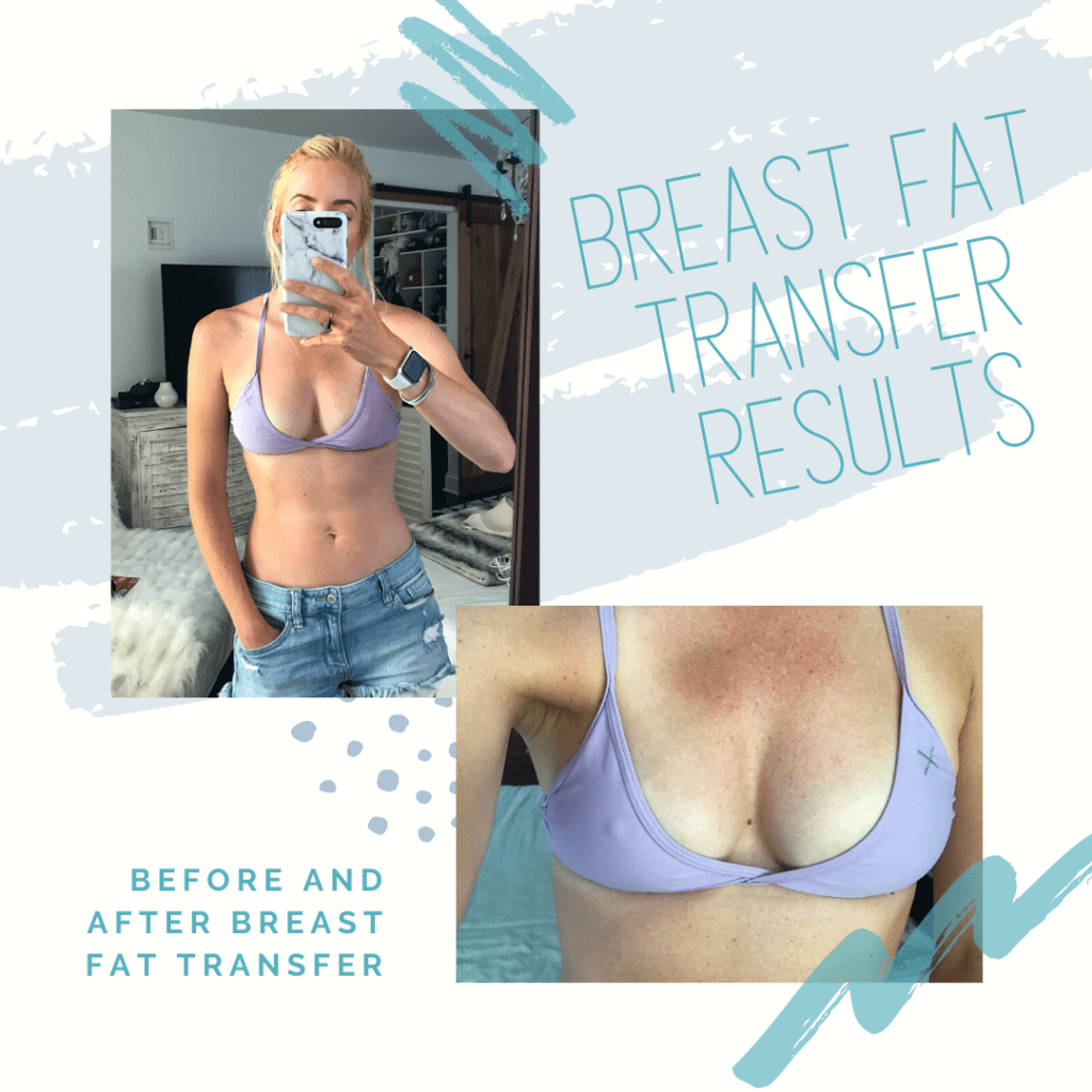 Bednar Cosmetic on X: Here's a Before & After of a Fat Transfer